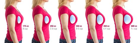 breast augmentation grand rapids|225cc breast implants.